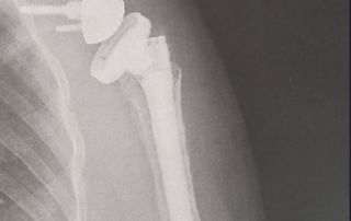 Personal Injury Arm Photo