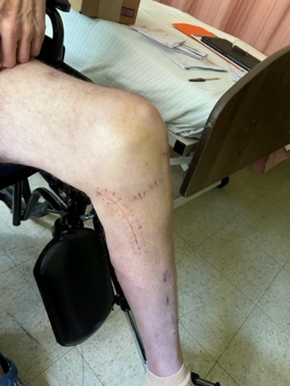 Dump Truck Crash Injury