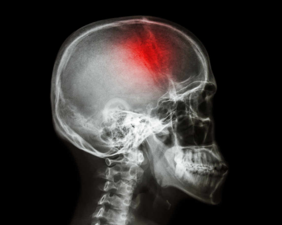 traumatic Brain_injury_personal_injury_lawyers traumatic_Brain_injury_personal_injury_lawyers